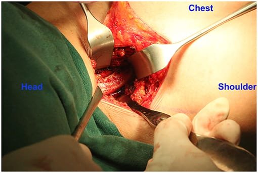 Thoracic Outlet Decompression Procedure