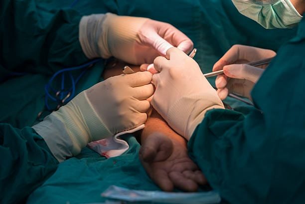 AV Fistula Illustration