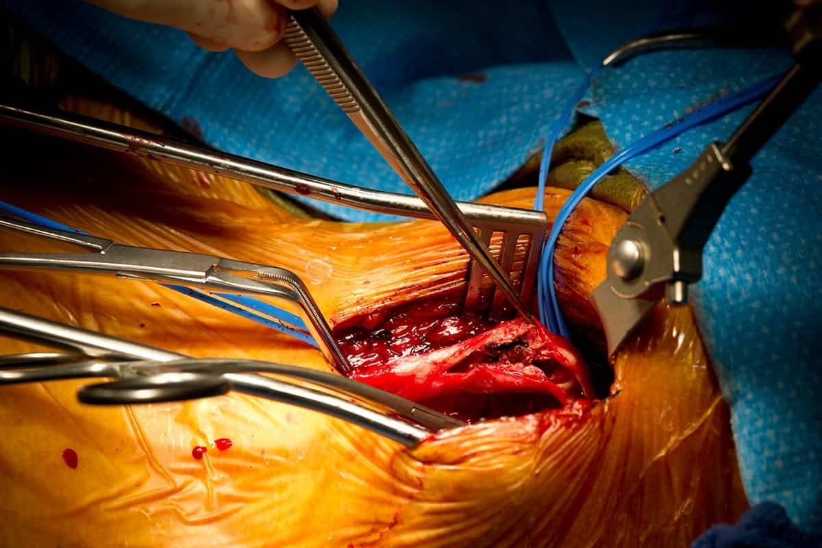 Vascular Procedure