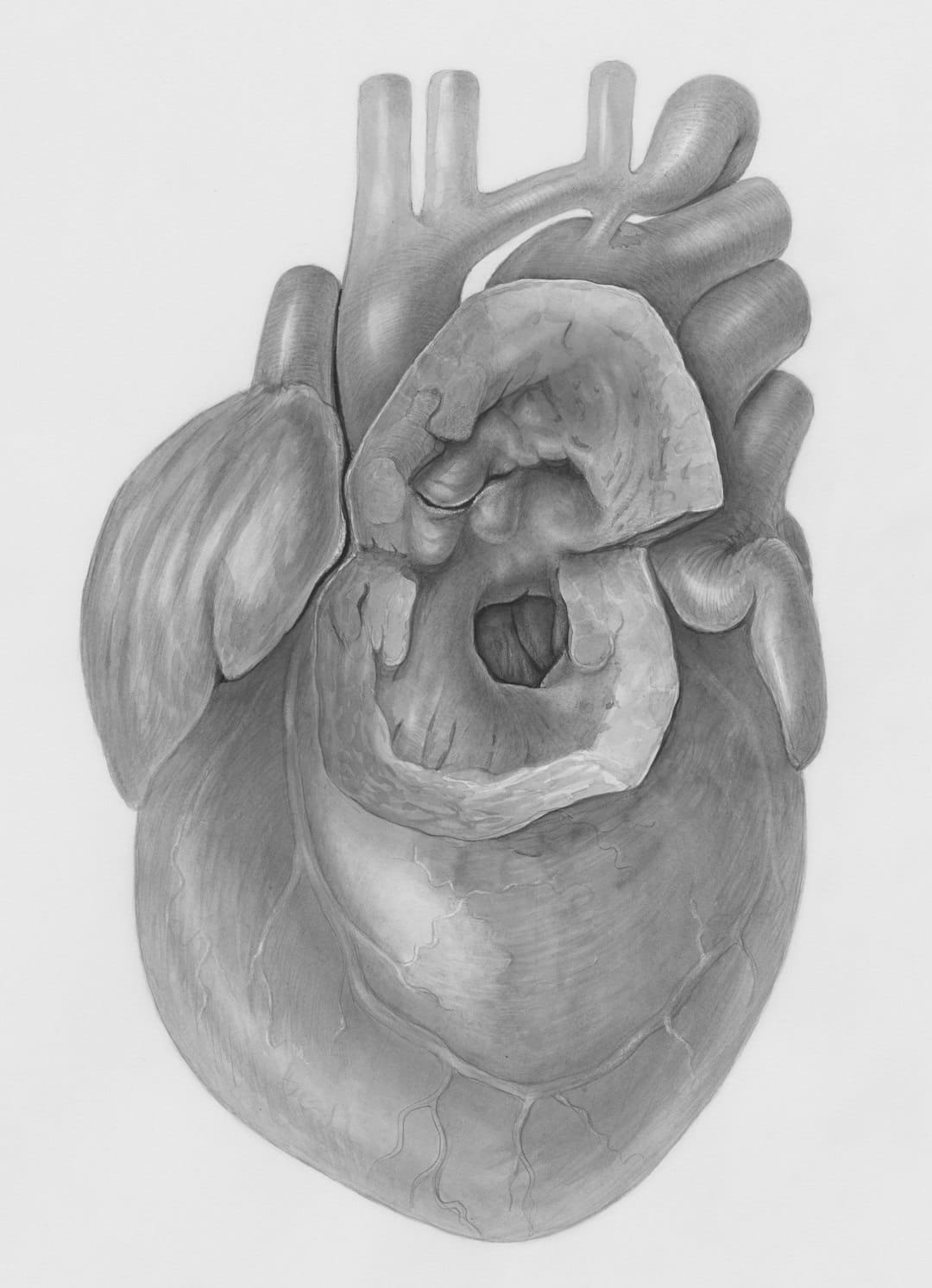 Congenital Heart Surgery Procedure in Delhi