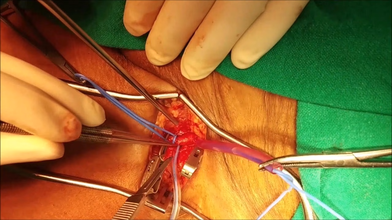 Blood Clot Removal Procedure
