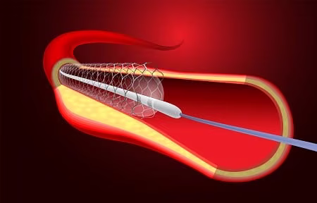 AV Fistula Procedure