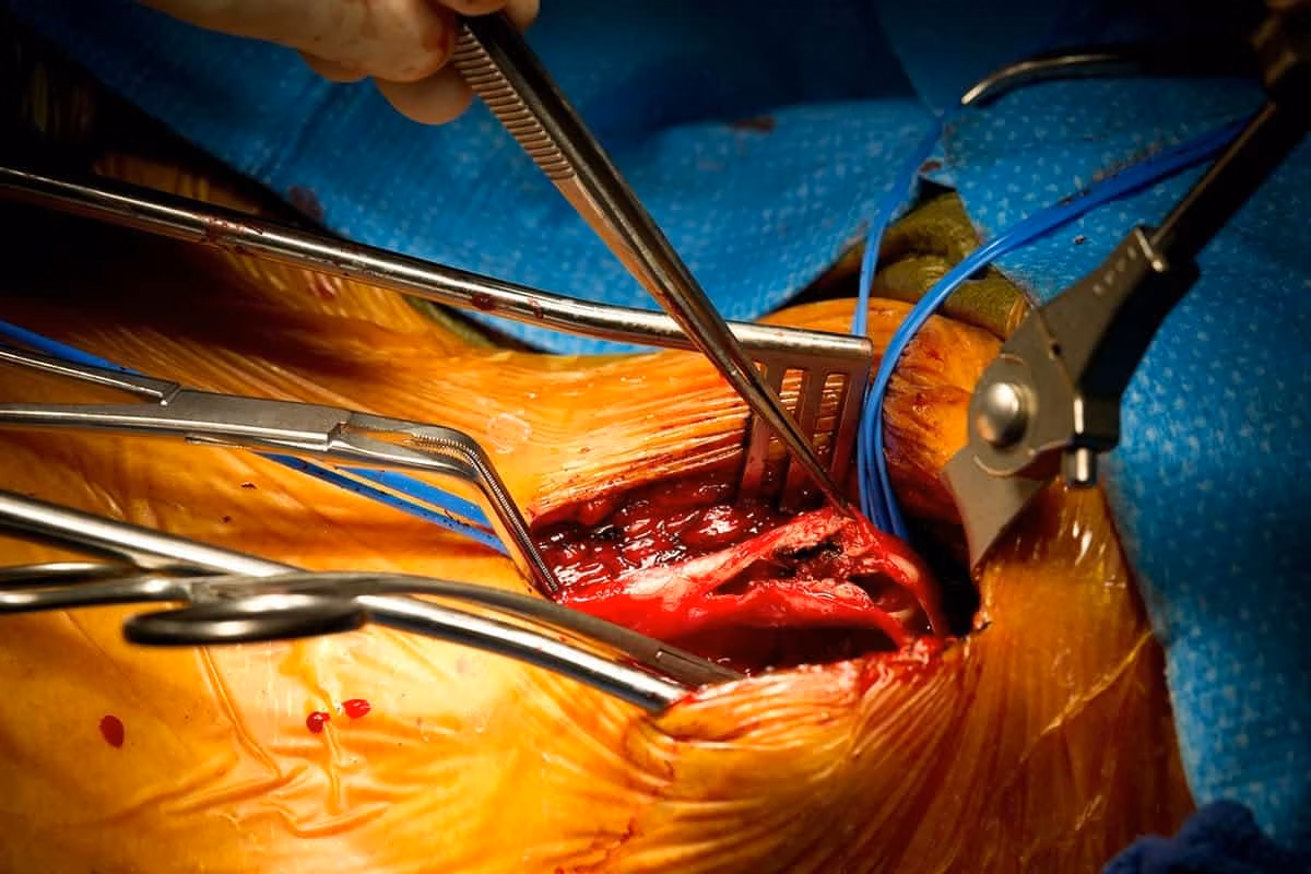 Vascular Procedure